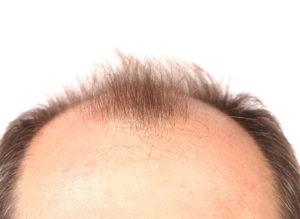 baldness treatment